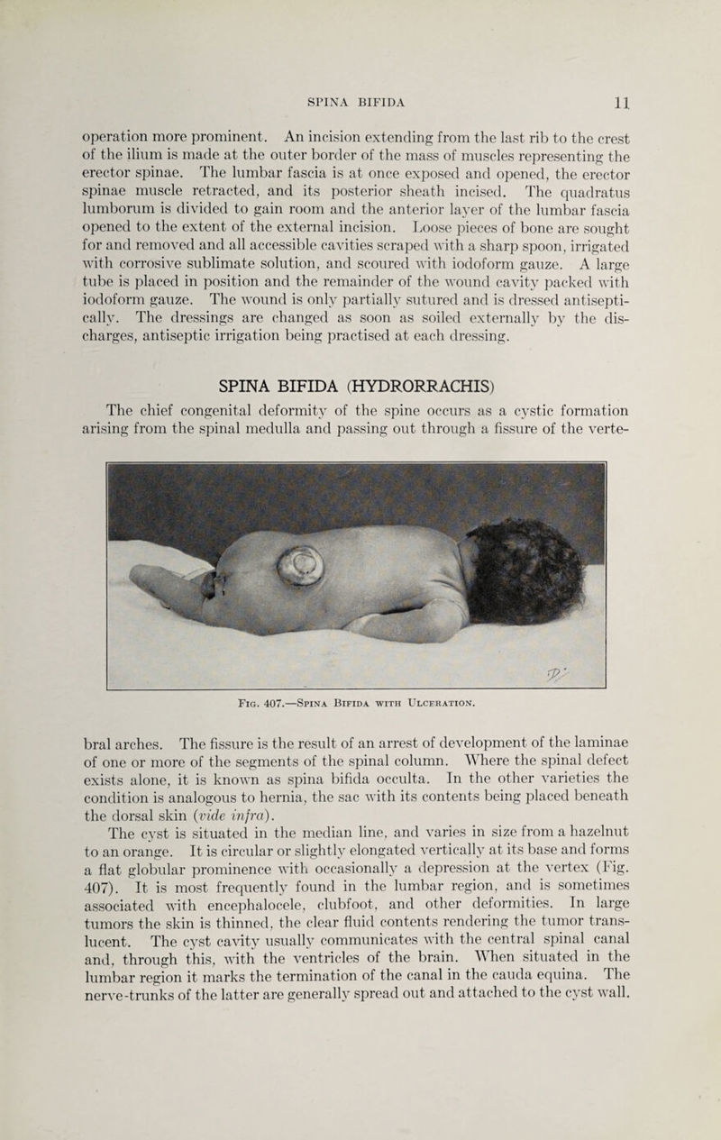 operation more prominent. An incision extending from the last rib to the crest of the ilium is made at the outer border of the mass of muscles representing the erector spinae. The lumbar fascia is at once exposed and opened, the erector spinae muscle retracted, and its posterior sheath incised. The quadratus lumborum is divided to gain room and the anterior layer of the lumbar fascia opened to the extent of the external incision. Loose pieces of bone are sought for and removed and all accessible cavities scraped with a sharp spoon, irrigated with corrosive sublimate solution, and scoured with iodoform gauze. A large tube is placed in position and the remainder of the wound cavity packed with iodoform gauze. The wound is only partially sutured and is dressed antisepti- callv. The dressings are changed as soon as soiled externally by the dis¬ charges, antiseptic irrigation being practised at each dressing. SPINA BIFIDA (HYDRORRACHIS) The chief congenital deformity of the spine occurs as a cystic formation arising from the spinal medulla and passing out through a fissure of the verte- Fig. 407.—Spina Bifida with Ulcfration. bral arches. The fissure is the result of an arrest of development of the laminae of one or more of the segments of the spinal column. Where the spinal defect exists alone, it is known as spina bifida occulta. In the other varieties the condition is analogous to hernia, the sac with its contents being placed beneath the dorsal skin (vide infra). The cyst is situated in the median line, and varies in size from a hazelnut to an orange. It is circular or slightly elongated vertically at its base and forms a flat globular prominence with occasionally a depression at the vertex (Fig. 407). It is most frequently found in the lumbar region, and is sometimes associated with encephalocele, clubfoot, and other deformities. In large tumors the skin is thinned, the clear fluid contents rendering the tumor trans¬ lucent. The cyst cavity usually communicates with the central spinal canal and, through this, with the ventricles of the brain. When situated in the lumbar region it marks the termination of the canal in the cauda equina. The nerve-trunks of the latter are generally spread out and attached to the cyst wall.