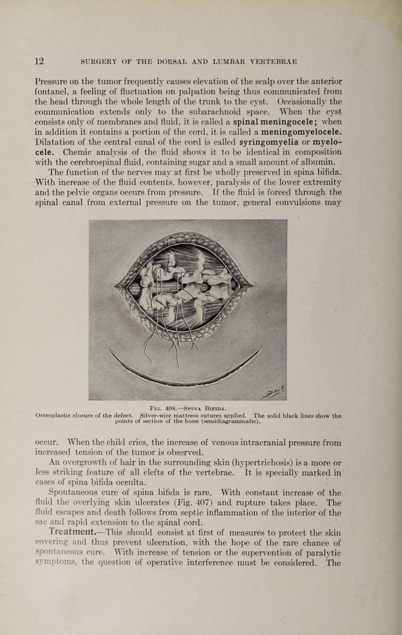 Pressure on the tumor frequently causes elevation of the scalp over the anterior fontanel, a feeling of fluctuation on palpation being thus communicated from the head through the whole length of the trunk to the cyst. Occasionally the communication extends only to the subarachnoid space. When the cyst consists only of membranes and fluid, it is called a spinal meningocele; when in addition it contains a portion of the cord, it is called a meningomyelocele. Dilatation of the central canal of the cord is called syringomyelia or myelo¬ cele. Chemic analysis of the fluid shows it to be identical in composition with the cerebrospinal fluid, containing sugar and a small amount of albumin. The function of the nerves may at first be wholly preserved in spina bifida. With increase of the fluid contents, however, paralysis of the lower extremity and the pelvic organs occurs from pressure. If the fluid is forced through the spinal canal from external pressure on the tumor, general convulsions may Fig. 408.—Spina Bifida. Osteoplastic closure of the defect. Silver-wire mattress sutures applied. The solid black lines show the points of section of the bone (semidiagrammatic). occur. When the child cries, the increase of venous intracranial pressure from increased tension of the tumor is observed. An overgrowth of hair in the surrounding skin (hypertrichosis) is a more or less striking feature of all clefts of the vertebrae. It is specially marked in cases of spina bifida occulta. Spontaneous cure of spina bifida is rare. With constant increase of the fluid the overlying skin ulcerates (Fig. 407) and rupture takes place. The fluid escapes and death follows from septic inflammation of the interior of the sac and rapid extension to the spinal cord. Treatment.—This should consist at first of measures to protect the skin covering and thus prevent ulceration, with the hope of the rare chance of spontaneous cure. With increase of tension or the supervention of paralytic symptoms, the question of operative interference must be considered. The