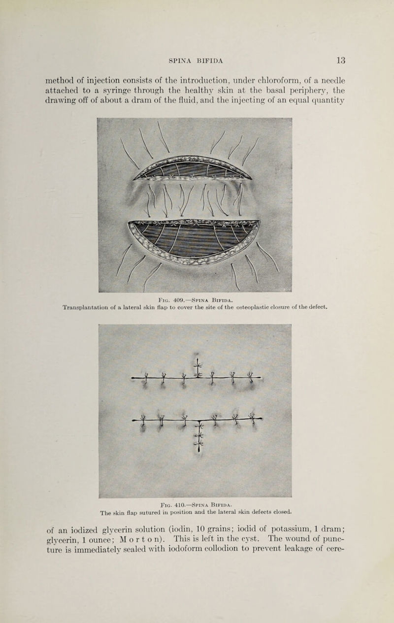 method of injection consists of the introduction, under chloroform, of a needle attached to a syringe through the healthy skin at the basal periphery, the drawing off of about a dram of the fluid, and the injecting of an equal quantity Fig. 409.—Spina Bifida. Transplantation of a lateral skin flap to cover the site of the osteoplastic closure of the defect. '* 1_Jl_ iJT j l i if ..'Jf V _jit_i1_M— > } ; j ■4*~ 4 1 v * t 4 Fig. 410.—Spina Bifida. The skin flap sutured in position and the lateral skin defects closed. of an iodized glycerin solution (iodin, 10 grains; iodid of potassium, 1 dram; glycerin, 1 ounce; M orton). This is left in the cyst. The wound of punc¬ ture is immediately sealed with iodoform collodion to prevent leakage of cere-