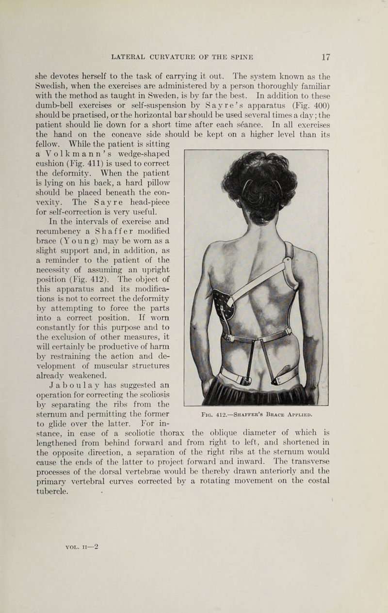 she devotes herself to the task of carrying it out. The system known as the Swedish, when the exercises are administered by a person thoroughly familiar with the method as taught in Swreden, is by far the best. In addition to these dumb-bell exercises or self-suspension by Sayre's apparatus (Fig. 400) should be practised, or the horizontal bar should be used several times a day; the patient should lie down for a short time after each seance. In all exercises the hand on the concave side should be kept on a higher level than its fellow. While the patient is sitting a Volkmann’s wedge-shaped cushion (Fig. 411) is used to correct the deformity. When the patient is lying on his back, a hard pillow should be placed beneath the con¬ vexity. The Sayre head-piece for self-correction is very useful. In the intervals of exercise and recumbency a Shaffer modified brace (Young) may be worn as a slight support and, in addition, as a reminder to the patient of the necessity of assuming an upright position (Fig. 412). The object of this apparatus and its modifica¬ tions is not to correct the deformity by attempting to force the parts into a correct position. If worn constantly for this purpose and to the exclusion of other measures, it will certainly be productive of harm by restraining the action and de¬ velopment of muscular structures already weakened. J a b o u 1 a y has suggested an operation for correcting the scoliosis by separating the ribs from the sternum and permitting the former Fig. 412.—Shaffer's Brace applied. to glide over the latter. For in¬ stance, in case of a scoliotic thorax the oblique diameter of which is lengthened from behind forward and from right to left, and shortened in the opposite direction, a separation of the right ribs at the sternum would cause the ends of the latter to project forward and inward. The transverse processes of the dorsal vertebrae would be thereby drawn anteriorly and the primary vertebral curves corrected by a rotating movement on the costal tubercle. VOL. 11—2