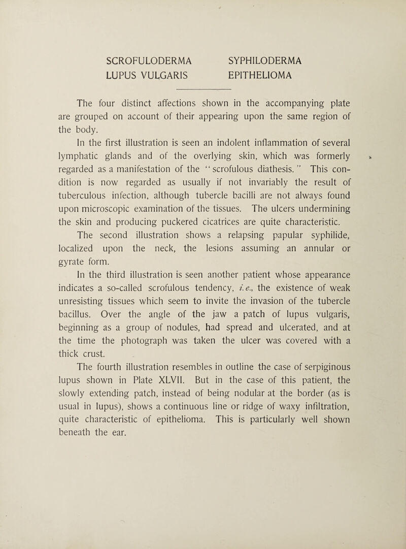 LUPUS VULGARIS EPITHELIOMA The four distinct affections shown in the accompanying plate are grouped on account of their appearing upon the same region of the body. In the first illustration is seen an indolent inflammation of several lymphatic glands and of the overlying skin, which was formerly regarded as a manifestation of the “scrofulous diathesis. *’ This con¬ dition is now regarded as usually if not invariably the result of tuberculous infection, although tubercle bacilli are not always found upon microscopic examination of the tissues. The ulcers undermining the skin and producing puckered cicatrices are quite characteristic. The second illustration shows a relapsing papular syphilide, localized upon the neck, the lesions assuming an annular or gyrate form. In the third illustration is seen another patient whose appearance indicates a so-called scrofulous tendency, i.e., the existence of weak unresisting tissues which seem to invite the invasion of the tubercle bacillus. Over the angle of the jaw a patch of lupus vulgaris, beginning as a group of nodules, had spread and ulcerated, and at the time the photograph was taken the ulcer was covered with a thick crust. The fourth illustration resembles in outline the case of serpiginous lupus shown in Plate XLVII. But in the case of this patient, the slowly extending patch, instead of being nodular at the border (as is usual in lupus), shows a continuous line or ridge of waxy infiltration, quite characteristic of epithelioma. This is particularly well shown beneath the ear.
