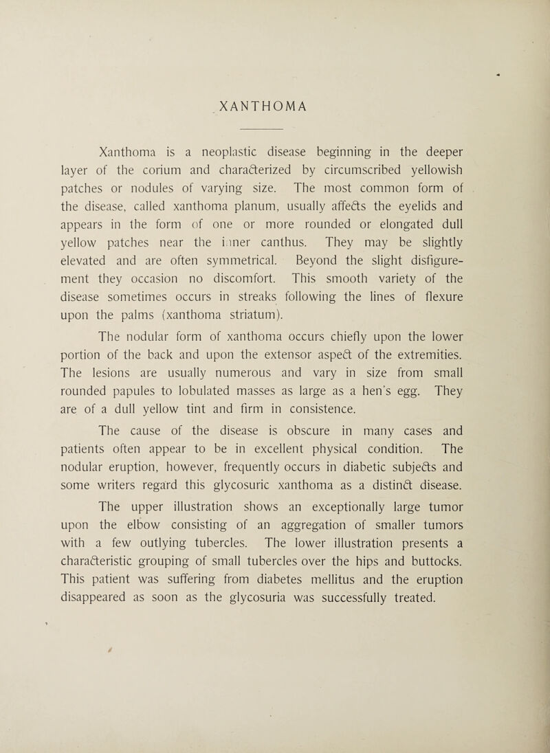 XANTHOMA Xanthoma is a neoplastic disease beginning in the deeper layer of the corium and characterized by circumscribed yellowish patches or nodules of varying size. The most common form of the disease, called xanthoma planum, usually affeCts the eyelids and appears in the form of one or more rounded or elongated dull yellow patches near the inner canthus. They may be slightly elevated and are often symmetrical. Beyond the slight disfigure¬ ment they occasion no discomfort. This smooth variety of the disease sometimes occurs in streaks following the lines of flexure upon the palms (xanthoma striatum). The nodular form of xanthoma occurs chiefly upon the lower portion of the back and upon the extensor aspeCt of the extremities. The lesions are usually numerous and vary in size from small rounded papules to lobulated masses as large as a hen’s egg. They are of a dull yellow tint and firm in consistence. The cause of the disease is obscure in many cases and patients often appear to be in excellent physical condition. The nodular eruption, however, frequently occurs in diabetic subjects and some writers regard this glycosuric xanthoma as a distinct disease. The upper illustration shows an exceptionally large tumor upon the elbow consisting of an aggregation of smaller tumors with a few outlying tubercles. The lower illustration presents a characteristic grouping of small tubercles over the hips and buttocks. This patient was suffering from diabetes mellitus and the eruption disappeared as soon as the glycosuria was successfully treated.