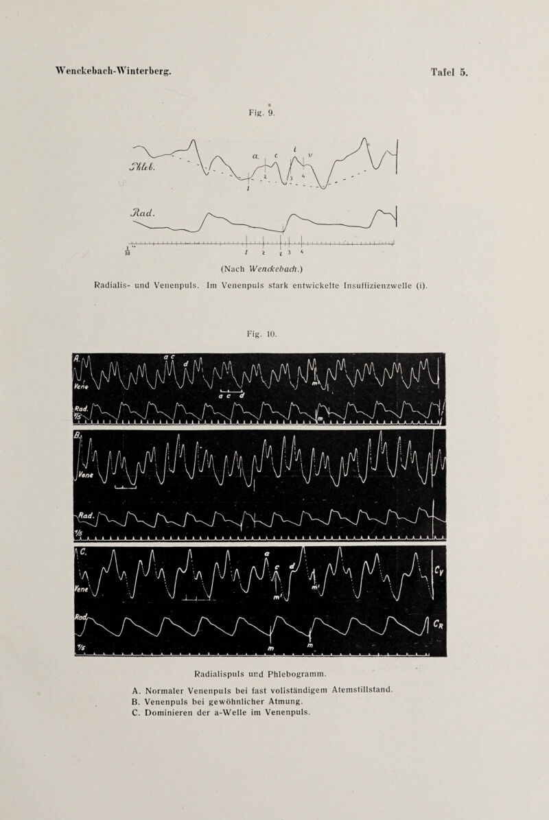 Fig. 9. Radialis- und Venenpuls. Im Venenpuls stark entwickelte Insuffizienzwelle (i). Fig. 10. Radialispuls und Phlebogramm. A. Normaler Venenpuls bei fast vollständigem Atemstillstand. B. Venenpuls bei gewöhnlicher Atmung. C. Dominieren der a-Welle im Venenpuls.