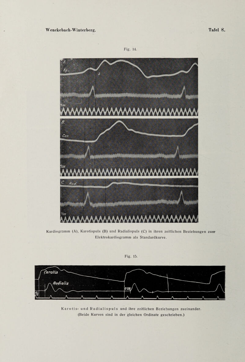 Kardiogramm (A), Karotispuls (B) und Radialispuls (C) in ihren zeitlichen Beziehungen zunr Elektrokardiogramm als Standardkurve. Fig. 15. Karotis- und Radialispuls und ihre zeitlichen Beziehungen zueinander. (Beide Kurven sind in der gleichen Ordinate geschrieben.)