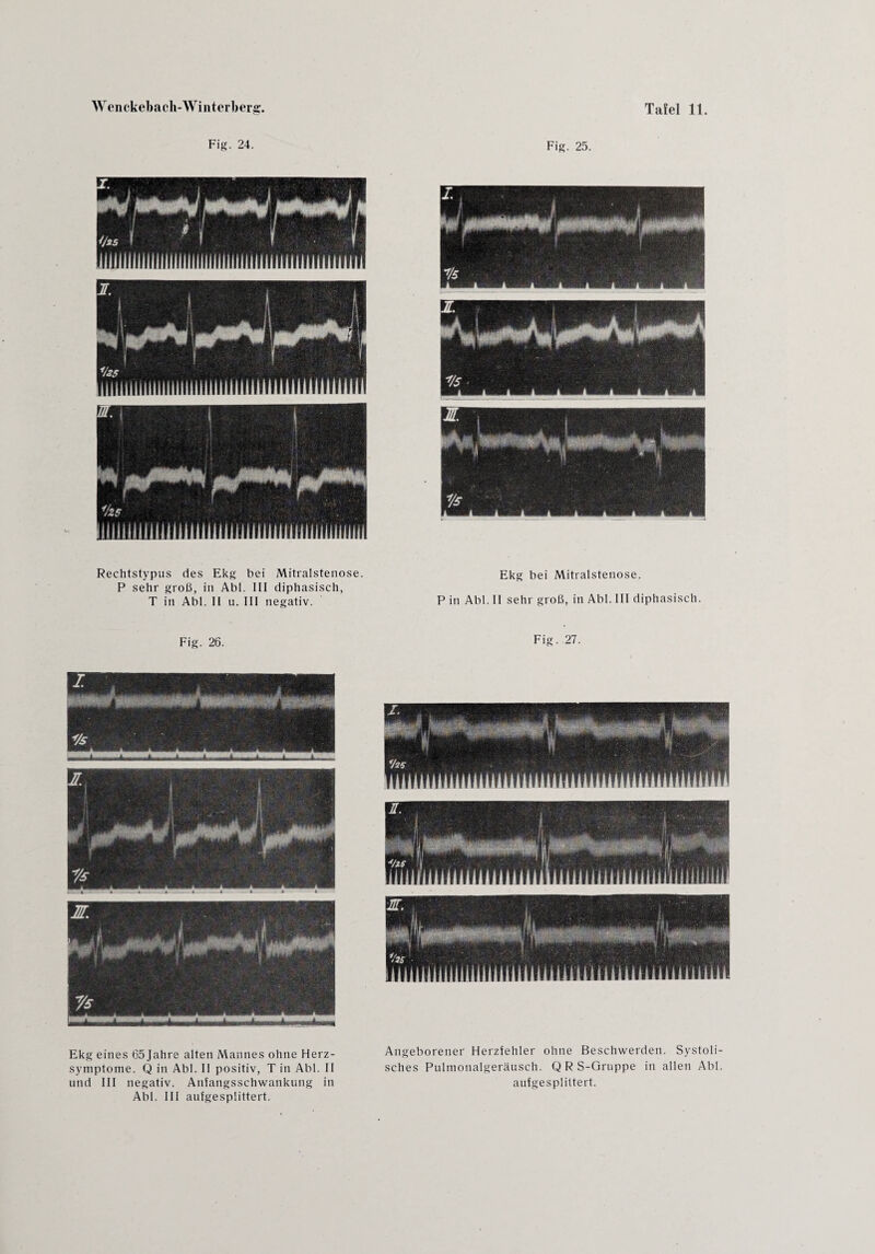 Fig. 24. Fig. 25. Rechtstypus des Ekg bei Mitralstenose. P sehr groß, in Abi. III diphasisch, T in Abi. II u. III negativ. Ekg bei Mitralstenose. P in Abi. II sehr groß, in Abi. III diphasisch. Fig. 26. Fig. 27. Ekg eines 65Jahre alten Mannes ohne Herz¬ symptome. Q in Abi. II positiv, T in Abi. II und III negativ. Anfangsschwankung in Abi. III aufgesplittert. Angeborener Herzfehler ohne Beschwerden. Systoli¬ sches Pulmonalgeräusch. Q R S-Gruppe in allen Abi. aufgesplittert.