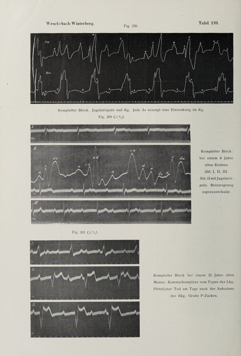 Fig. 259. Kompletter Block. Jugularispuls und Kg. Jede As erzeugt eine Einsenkung im Kg. Fig. 260 (X 4A,). i ■ f *hs r iiiiGiiiimmimiiiiiiimii f r ii n iii h h i i i m n i n i n i u n t a i m i n i * * iiiiiiiiiiiimiiiiiiiiiiimHiuiiiiimiuii IftlllflflYf iiiiiiiiiiinimiiYiivmmvu iimmivfiiiiviiiiiiiiiinmmiiMifiiii Kompletter Block bei einem 8 Jahre alten Knaben. Abi. I, II, III. Abi. II mit Jugularis¬ puls. Reizursprung supraventrikulär. Fig. 261 (X-Vs)- Kompletter Block bei einem 52 Jahre alten Manne. Kammerkomplexe vom Typus des Lkg. Plötzlicher Tod am Tage nach der Aufnahme des Ekg. Große P-Zacken.