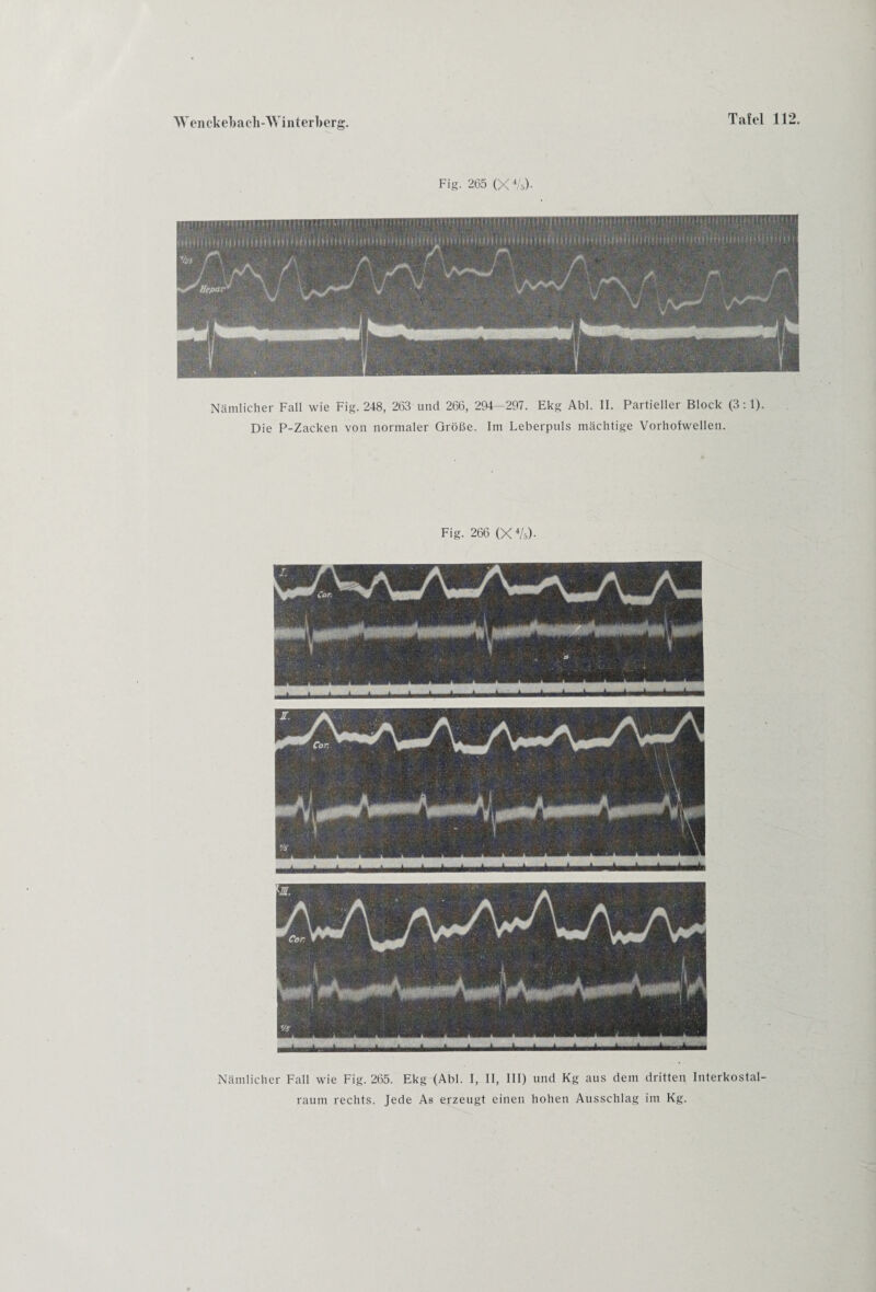 Fig. 265 (X4/r,)- Nämlicher Fall wie Fig. 248, 263 und 266, 294—297. Ekg Abi. II. Partieller Block (3:1). Die P-Zacken von normaler Größe. Im Leberpuls mächtige Vorholwellen. Fig. 266 (X4/ä)- Nämlicher Fall wie Fig. 265. Ekg (Abi. I, II, III) und Kg aus dem dritten Interkostal¬ raum rechts. Jede As erzeugt einen hohen Ausschlag im Kg.