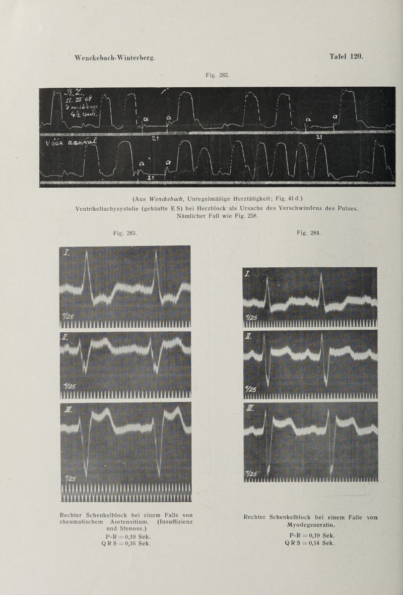 W e n ckcb a c h-W i nt er ber g. Fig. 282. Ventrikeltachysystolie (gehäufte ES) bei Herzblock als Ursache des Verschwindens des Pulses. Nämlicher Fall wie Fig. 258. Fig. 283. Fig. 284. Rechter Schenkelblock bei einem Falle von rheumatischem Aortenvitium. (Insuffizienz und Stenose.) P-R = 0,19 Sek. Q R S - 0,16 Sek. Rechter Schenkelblock bei einem Falle von Myodegeneratio. P-R =0,19 Sek. QRS = 0,14 Sek.