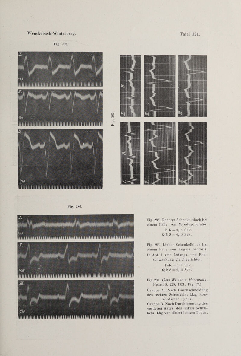 Fig. 286. Fig. 285. Rechter Sehenkelblock bei einem Falle von Myodegeneratio. P-R = 0,14 Sek. QR S = 0,16 Sek. Fig. 286. Linker Schenkelblock bei einem Falle von Angina pectoris. In Abi. I sind Anfangs- und End¬ schwankung gleichgerichtet. P-R =0,17 Sek. QR S = 0,16 Sek. Fig. 287. (Aus Wilson u. Herrmann, Heart, 8, 229, 1921; Fig. 27.) Gruppe A. Nach Durchschneidung des rechten Schenkels: Lkg, kon¬ kordanter Typus. Gruppe B. Nach Durchtreunung des vorderen Astes des linken Schen¬ kels : Lkg von diskordantem Typus.