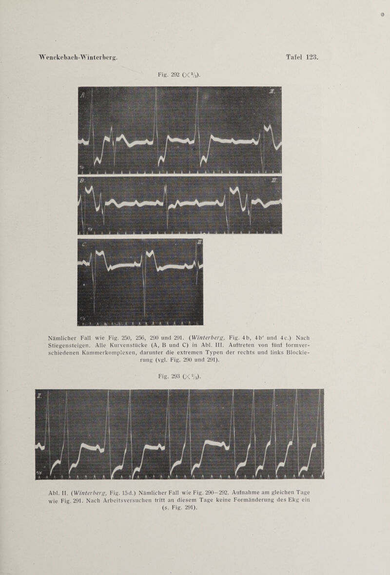 Fig. 292 (X2/3). Nämlicher Fall wie Fig. 250, 256, 290 und 291. (Winterberg, Fig. 4b, 4b' und 4c.) Nach Stiegensteigen. Alle Kurvenstücke (A, B und C) in Abi. III. Auftreten von fünf formver¬ schiedenen Kammerkomplexen, darunter die extremen Typen der rechts und links Blockie¬ rung (vgl. Fig. 290 und 291). Fig. 293 (X2/3). Abi. II. (Winterberg, Fig. 15d.) Nämlicher Fall wie Fig. 290—292. Aufnahme am gleichen Tage wie Fig. 291. Nach Arbeitsversuchen tritt au diesem Tage keine Formänderung des Ekg ein (s. Fig. 291).