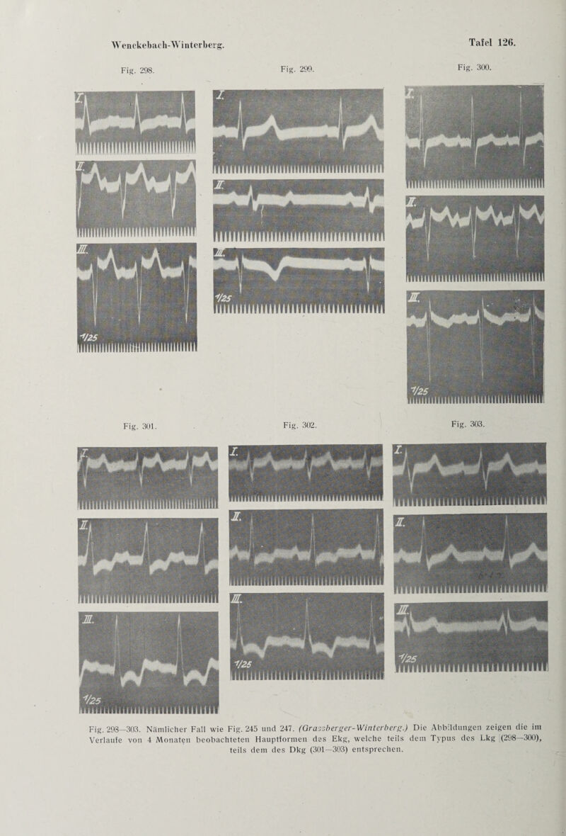 Fig. 298. Fig. 299. Fig. 300. Fig. 298—303. Nämlicher Fall wie Fig. 245 und 247. (Grassberger-Winterberg.) Die Abbildungen zeigen die im Verlaufe von 4 Monaten beobachteten Hauptformen des Ekg, welche teils dem Typus des Lkg (298—300), teils dem des Dkg (301—303) entsprechen.