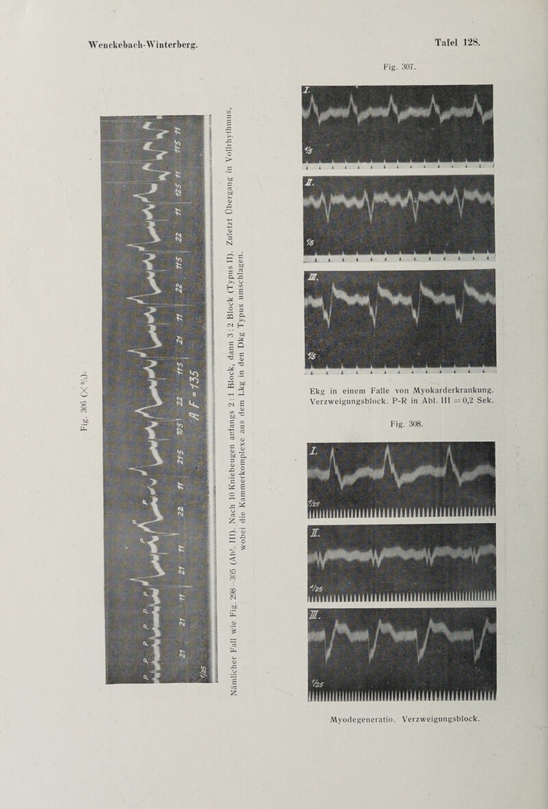 ’(7sX) 90e '§!d > b£ cC 0> X) 0) b = oa G, >> CM b£ KO z Tafel 128. Fig. 307. Ekg in einem Falle von Myokarderkrankung. Verzweigungsbloek. P-R in Abi. III =0,2 Sek. Fig. 308. Myodegeneratlo. Verzweigungsblock.