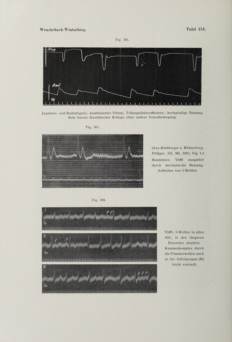 Fig. 366. Jugularis- und Radialispuls: kombiniertes Vitium, Trikuspidalinsutfizienz ; hochgradige Stauung. Sehr kurzer diastolischer Kollaps ohne andere Venenbewegung. Fig. 367. (Aus Rothberger u. Winterberg, Pflüger, 131, 387, 1910; Fig. 1.) Hundeherz. Vhffl ausgelöst durch mechanische Reizung. Auftreten von f-Wellen. Fig. 368. Vhffl; f-Wellen in allen Abi., in den längeren Diastolen deutlich. Kammerkomplex durch die Flimmerwellen auch in der Initialgruppe (R) leicht entstellt.