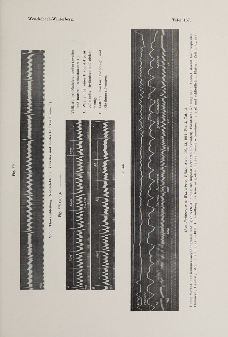 Vhffl. Thoraxableitung. Nadelelektroden (zweiter und fünfter Interkostalraurn r ). ^ r“ 3 £ w ^ TJ •- * I c CO cd Vh c/3 b£ b£ O C 3 cd cd o ^ ^ N ! 1 O) CT s ?> - _c x E £ 1 -C CJ T3 o. 53 r-* Tf Tt« ts 3 5 > .c •c Uh u, cc £ :cd f—1 53 .3 O 53 Uh 5 Ä U 3 :0 +-* > 'S £ 3 0> :cd -4—> _b£ 0) .3 ’S £ '4— C/3 ’S > 5 u :0 t— '4—' <H— 3 < -4-» >> oc <