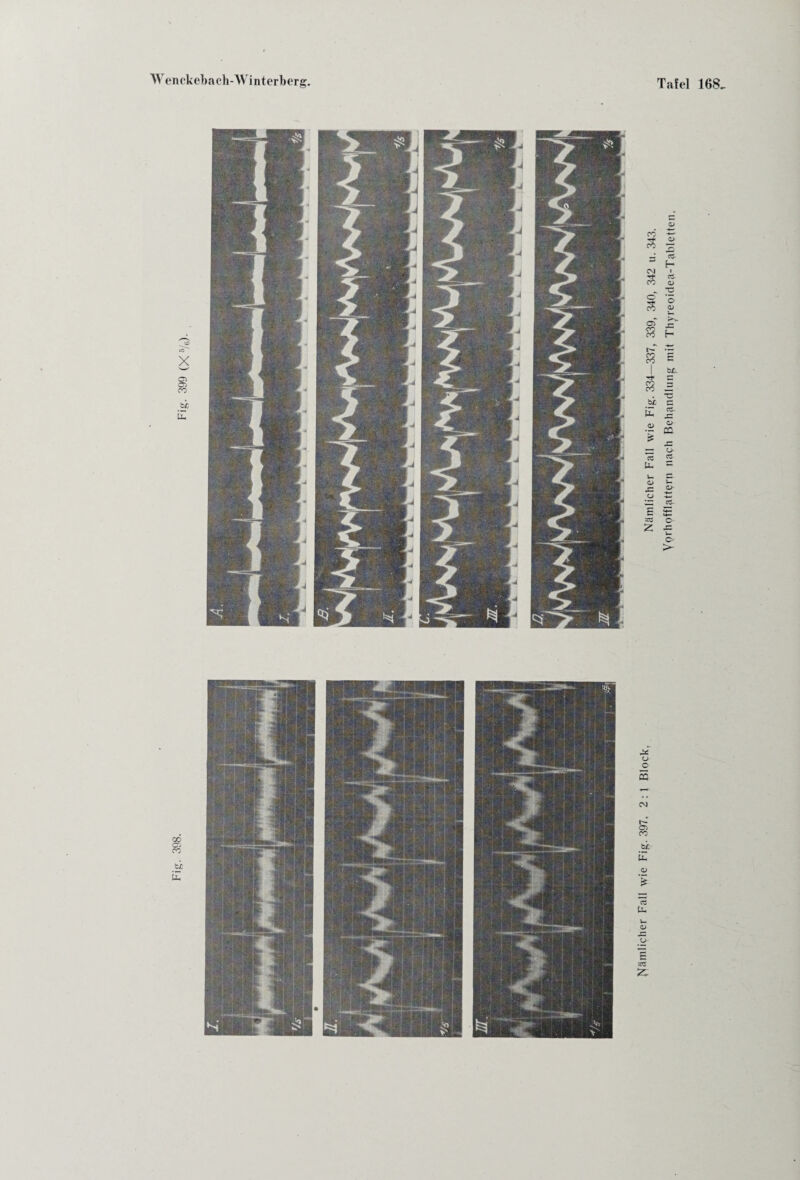 Nämlicher Fall wie Fig. 334—337, 339, 340, 342 u. 343. Vorhofflattern nach Behandlung mit Thyreoidea-Tabletten,