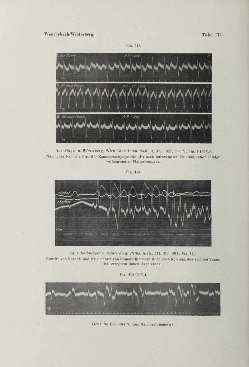 Fig. 414. Aus Singer u. Winterberg, Wien. Arch. f. inn. Med., 3, 329, 1922; Taf. V, Fig. 1 (X2/*). Nämlicher Fall wie Fig. 413. Kammertachysystolie (B) nach intravenöser Chinininjektion infolge verlangsamter Flatterfrequenz. Fig. 415. (Aus Rothberger u. Winterberg, Pflüg. Arch., 141, 343, 1911; Fig. 11.) Eintritt von Vorhof- und bald darauf von Kammerflimmern kurz nach Reizung des rechten Vagus bei erregtem linken Accelerans. Fig. 416 (X3/4)- Gehäufte ES oder kurzes Kammerflimmern?