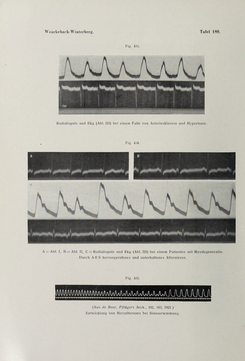 Fig. 433. Radialispuls und Ekg (Abi. III) bei einem Falle von Arteriosklerose und Hypertonie. Fig. 434. A = Abl. I, B = Abi. II, C = Radialispuls und Ekg (Abi. III) bei einem Patienten mit Myodegeneratio. Durch AES hervorgerufenes und unterhaltenes Alternieren. Fig. 435. (Aus de Boer, Pflügers Arch., 192, 183, 1921.) Entwicklung von Herzalternans bei Sinuserwärmung.