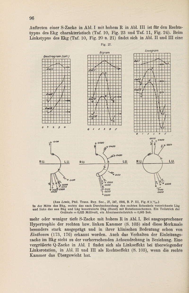 Auftreten einer S-Zacke in Abi. I mit hohem R in Abi. III ist für den Rechts¬ typus des Ekg charakteristisch (Taf. 10, Fig. 23 und Taf. 11, Fig. 24). Beim Linkstypus des Ekg (Taf. 10, Fig. 20 u. 21) findet sich in Abi. II und III eine Fig. 27. Dextrogram (cafc) 0 y z 3 4- 0 1 * 3 f S Lev ogram. ozso (Aus Lewis, Phil. Trans. Roy. Soc., 27, 247, 1916, B. P. III, Fig. 8 X 9/io-) In der Mitte das Bkg, rechts das nach Durchschneidung des rechten Schenkels verzeichnete Lkg und links das aus Bkg und Lkg konstruierte Dkg (Hund) mit Rotationsschemen. Ein Teilstrich der Ordinate = 0,025 Millivolt, ein Abszissenteilstrich = 0,005 Sek. mehr oder weniger tiefe S-Zacke mit hohem R in Abi. I. Bei ausgesprochener Hypertrophie der rechten bzw. linken Kammer (S. 103) sind diese Merkmale besonders stark ausgeprägt und in ihrer klinischen Bedeutung schon von Einthoven (173, 176) erkannt worden. Auch das Verhalten der Einleitungs¬ zacke im Bkg steht zu der vorherrschenden Achsendrehung in Beziehung. Eine vergrößerte Q-Zacke in Abi. I findet sich als Linkseffekt bei überwiegender Linksrotation, in Abi. II und III als Rechtseffekt (S. 103), wenn die rechte Kammer das Übergewicht hat.