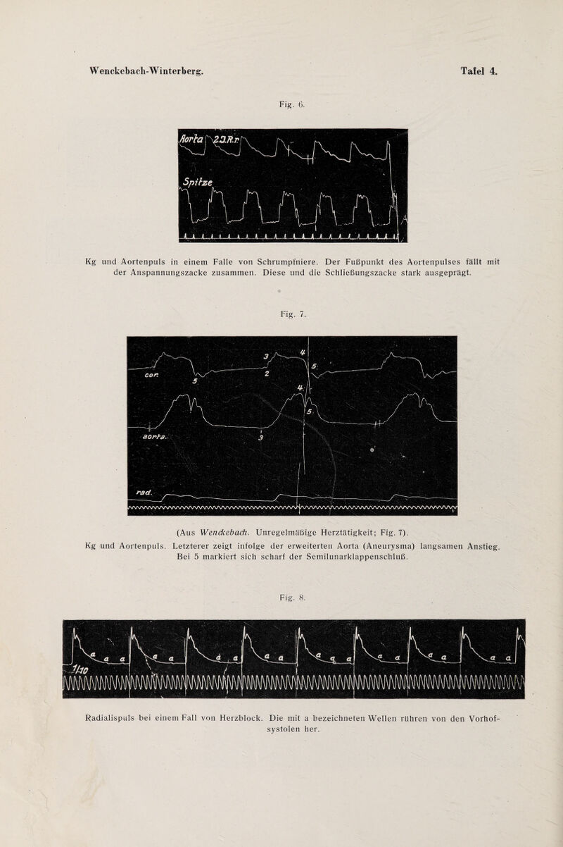 Fig. 6. Kg und Aortenpuls in einem Falle von Schrumpfniere. Der Fußpunkt des Aortenpulses fällt mit der Anspannungszacke zusammen. Diese und die Schließungszacke stark ausgeprägt. Fig. 7. (Aus Wenckebach. Unregelmäßige Herztätigkeit; Fig. 7). Kg und Aortenpuls. Letzterer zeigt infolge der erweiterten Aorta (Aneurysma) langsamen Anstieg. Bei 5 markiert sich scharf der Semilunarklappenschluß. Fig. 8. Radialispuls bei einem Fall von Herzblock. Die mit a bezeichneten Wellen rühren von den Vorhof¬ systolen her.