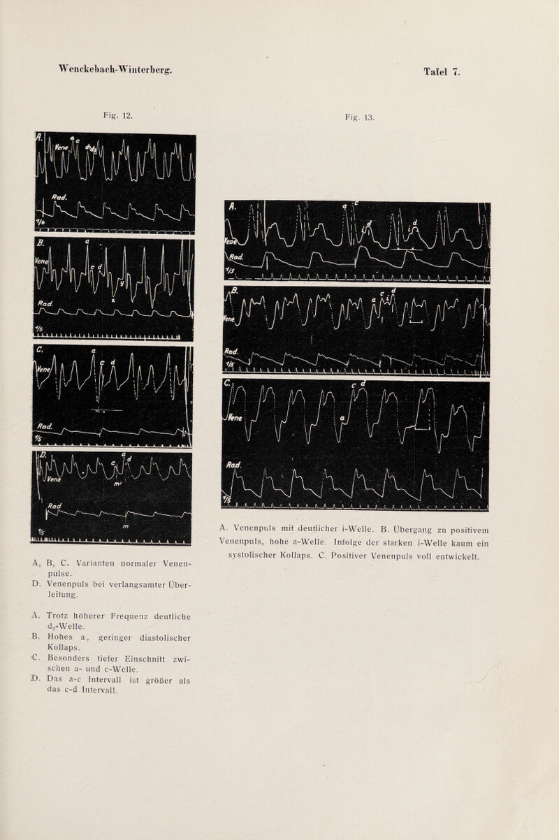 Fig. 12. A, B, C. Varianten normaler Venen¬ pulse. D. Venenpuls bei verlangsamter Über¬ leitung. Fig. 13. A. Venenpuls mit deutlicher i-Weile. B. Übergang zu positivem Venenpuls, hohe a-Welle. Infolge der starken i-Welle kaum ein systolischer Kollaps. C. Positiver Venenpuls voll entwickelt. A. Trotz höherer Frequenz deutliche d,-Welle. B. Hohes a, geringer diastolischer Kollaps. C. Besonders tiefer Einschnitt zwi¬ schen a- und c-Welle. D. Das a-c Intervall ist größer als das c-d Intervall.