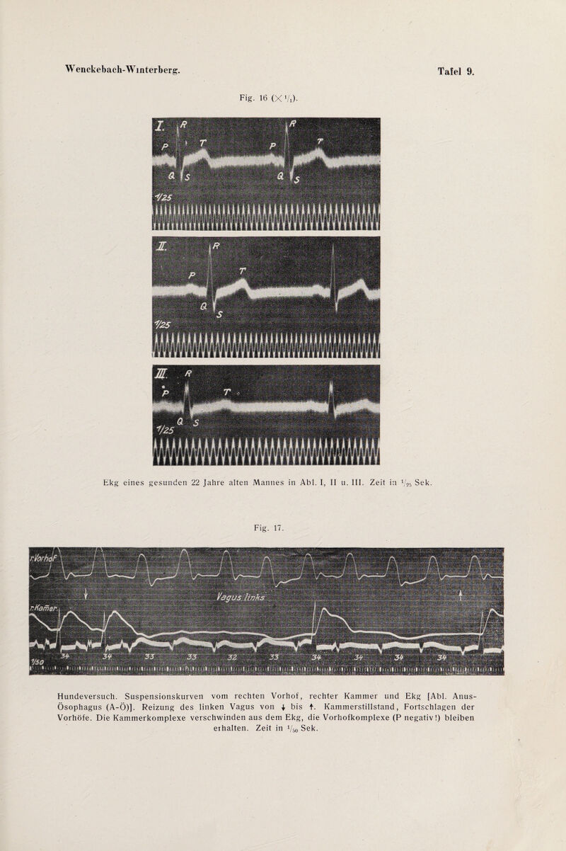 Fig. 16 (X1/,). Ekg eines gesunden 22 Jahre alten Mannes in Abi. I, II u. III. Zeit in Sek. Fig. 17. Hundeversuch. Suspensionskurven vom rechten Vorhof, rechter Kammer und Ekg [Abi. Anus- Ösophagus (A-Ö)]. Reizung des linken Vagus von | bis t. Kammerstillstand, Fortschlagen der Vorhöfe. Die Kammerkomplexe verschwinden aus dem Ekg, die Vorhofkomplexe (P negativ!) bleiben erhalten. Zeit in Vso Sek.