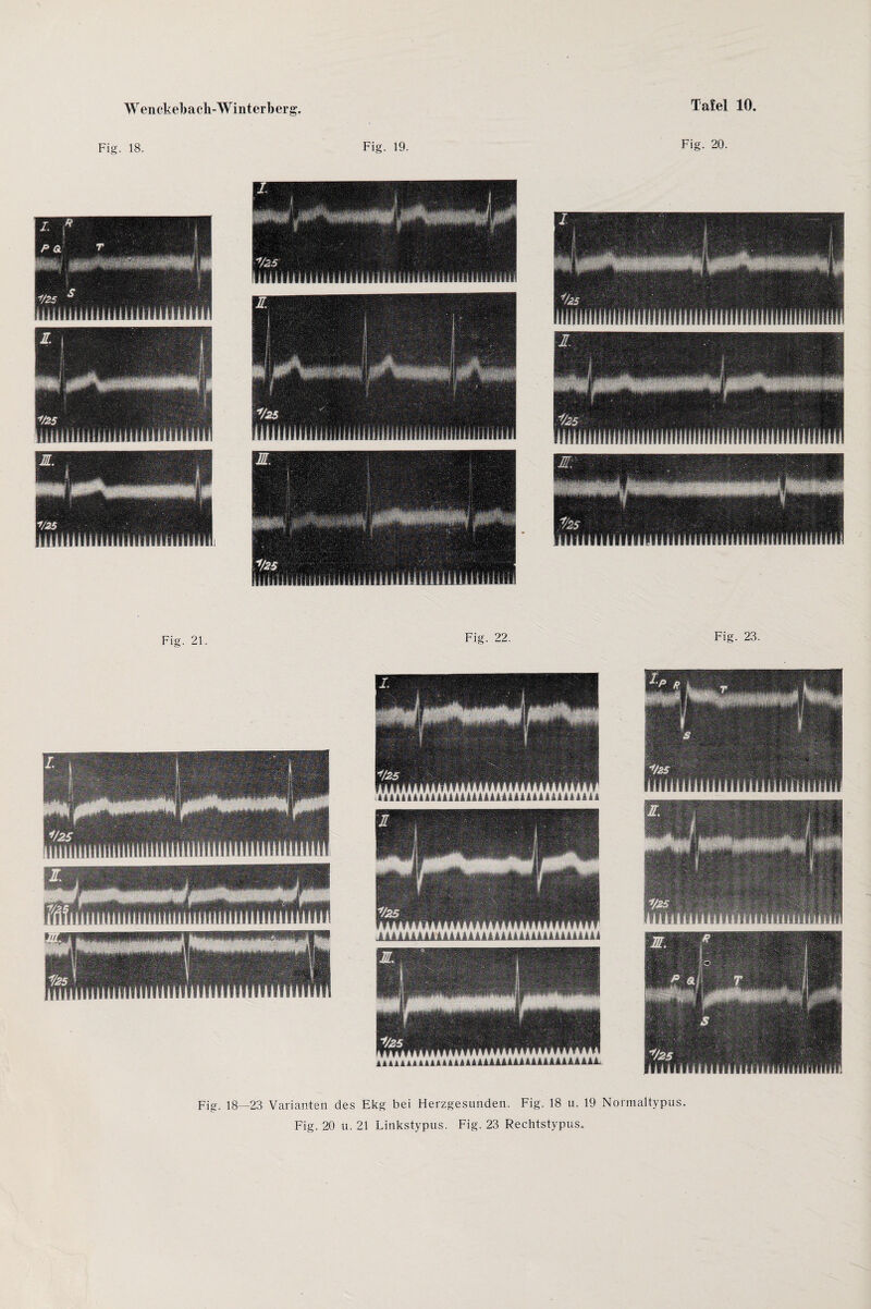 Fig. 18. Fig. 19. Fig. 20. Fig. 21. Fig. 22. Fig. 23. Fig. 18—23 Varianten des Ekg bei Herzgesunden. Fig. 18 u. 19 Normaltypus. Fig. 20 u. 21 Linkstypus. Fig. 23 Rechtstypus.