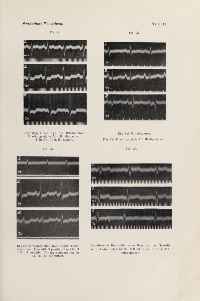 Fig. 24. Fig. 25. Rechtstypus des Ekg bei Mitralstenose. P sehr groß, in Abi. III diphasisch, T in Abi. II u. III negativ. Ekg bei Mitralstenose. P in Abi. II sehr groß, in Abi. III diphasisch. Fig. 26. Ekg eines 65Jahre alten Mannes ohne Herz¬ symptome. Q in Abi. II positiv, T in Abi. II und III negativ. Anfangsschwankung in Abi. III aufgesplittert. Fig. 27. Angeborener Herzfehler ohne Beschwerden. Systoli¬ sches Pulmonalgeräusch. QRS-Gruppe in allen Abi. aufgesplittert.