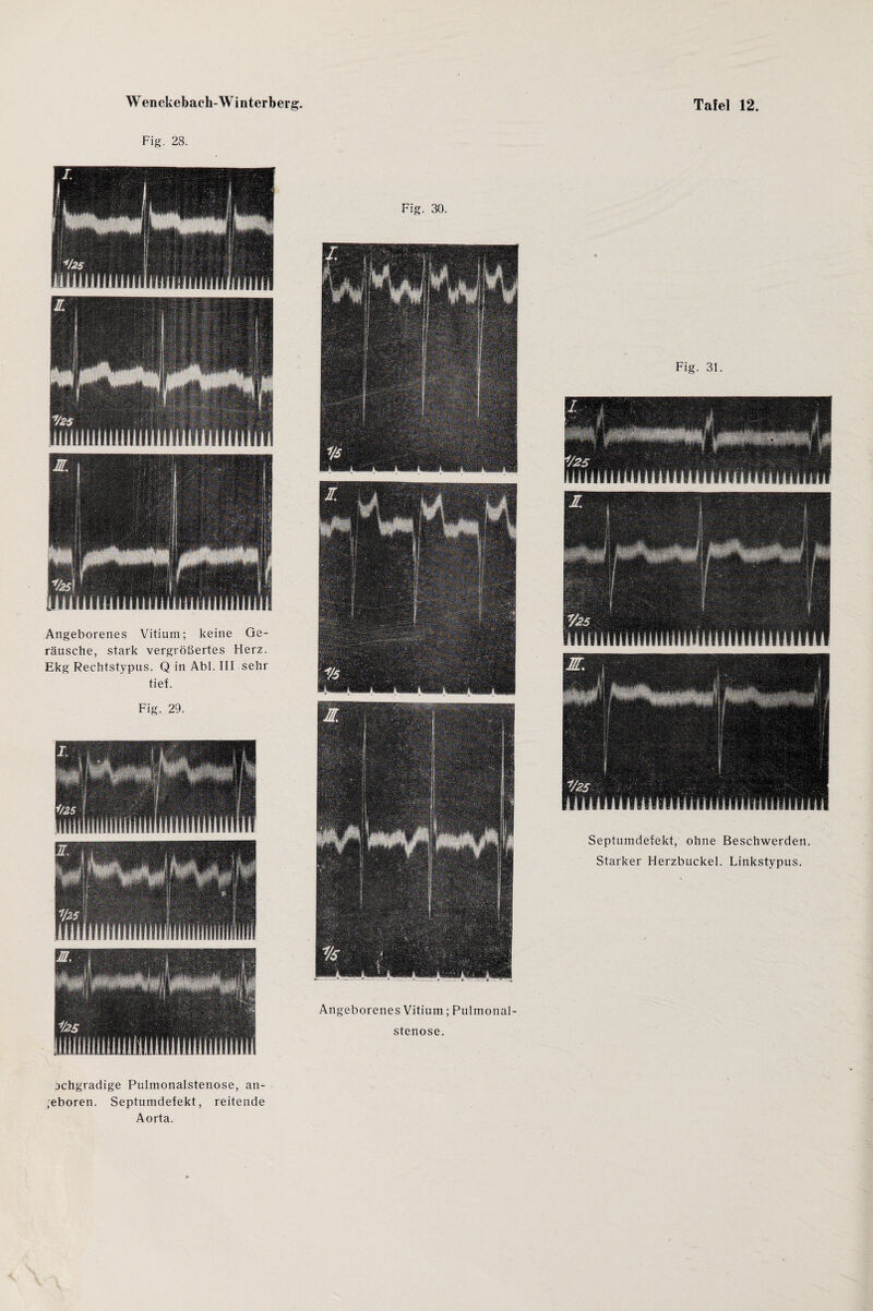Fig. 28. Angeborenes Vitium; keine Ge¬ räusche, stark vergrößertes Herz. Ekg Rechtstypus. Q in Abi. III sehr tief. Fig. 29. Fig. 30. Angeborenes Vitium; Pulmonal¬ stenose. Fig. 31. Septumdefekt, ohne Beschwerden. Starker Herzbuckel. Linkstypus. achgradige Pulmonalstenose, an¬ geboren. Septumdefekt, reitende Aorta.