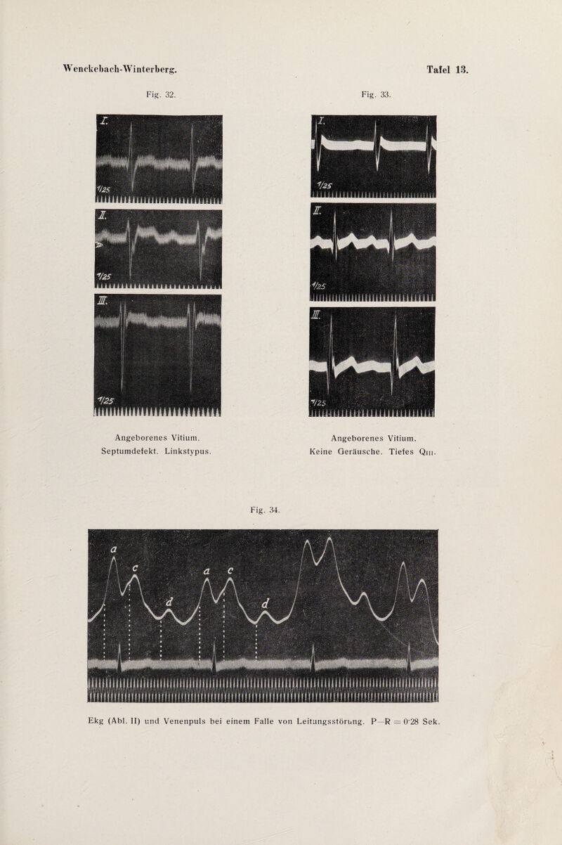 Fig. 32. Angeborenes Vitium. Septumdefekt. Linkstypus. Fig. 33. Angeborenes Vitium. Keine Geräusche. Tiefes Qm. Fig. 34. Ekg (Abi. II) und Venenpuls bei einem Falle von Leitungsstörung. P R = 0'28 Sek.