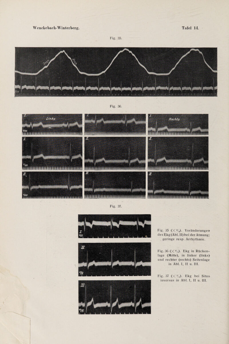 Fig. 35. Fig. 37. Fig. 35 (X3U)- Veränderungen des Ekg(Abl. II) bei der Atmung,- geringe resp. Arrhythmie. Fig. 36 (X'V.'O- Ekg in Rücken¬ lage (Mitte), in linker (links) und rechter (rechts) Seitenlage in Abi. I, II u. III. Fig. 37 (X Vi)- Ekg bei Situs inversus in Abi. I, II u. III.