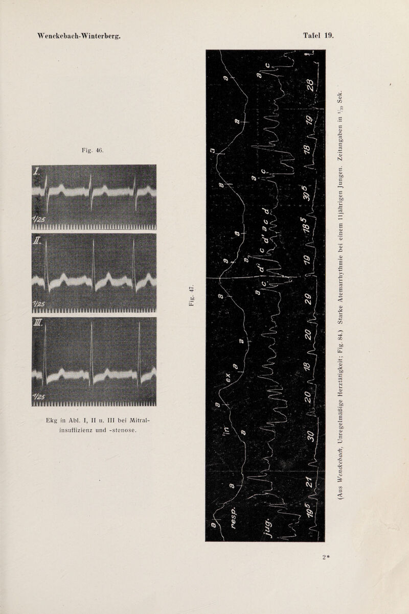 2 * (Aus Wenckebach, Unregelmäßige Herztätigkeit; Fig. 84.) Starke Atemarrhythmie bei einem 11jährigen Jungen. Zeitangaben in V30 Sek.