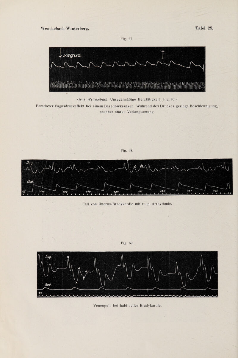 Fig. 67. 6 (Aus Wenckebach, Unregelmäßige Herztätigkeit; Fig. 76.) Paradoxer Vagusdruckeffekt bei einem Basedowkranken. Während des Druckes geringe Beschleunigung, nachher starke Verlangsamung. Fig. 68. Fall von Ikterus-Bradykardie mit resp. Arrhythmie. Fig. 69. Venenpuls bei habitueller Bradykardie.