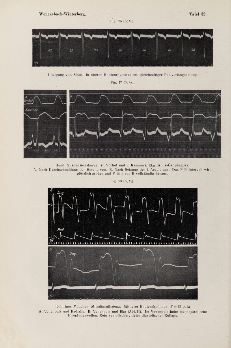 Fig. 76 (X4/.0- Übergang von Sinus- in oberen Knotenrhythmus mit gleichzeitiger Pulsverlangsamung. Fig. 77 (X 4/(.v i ■ i > t i. > Hund. Suspensionskurven (r. Vorhof und r. Kammer). Ekg (Anus-Ösophagus). A. Nach Durchschneidung der Herznerven. B. Nach Reizung des 1. Accelerans. Das P-R Intervall wird plötzlich größer und P tritt aus R vollständig heraus. Fig. 78 (X 4/ä). 19jähriges Mädchen, Mitralinsuffizienz. Mittlerer Knotenrhythmus. F = 43 p. M. A. Venenpuls und Radialis. B. Venenpuls und Ekg (Abi. II). Im Venenpuls hohe mesosystolische Pfropfungswellen. Kein systolischer, tiefer diastolischer Kollaps.