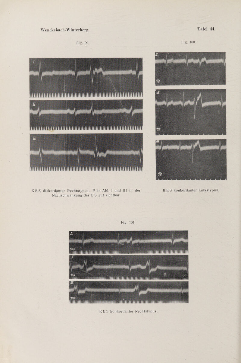 Fig. 99. Fig. 1Ü0. KES diskordanter Rechtstypus. P Nachschwankung der ES in Abi. I und gut sichtbar. III in der KES konkordanter Linkstypus. Fig. 101. KES konkordanter Rechtstypus.