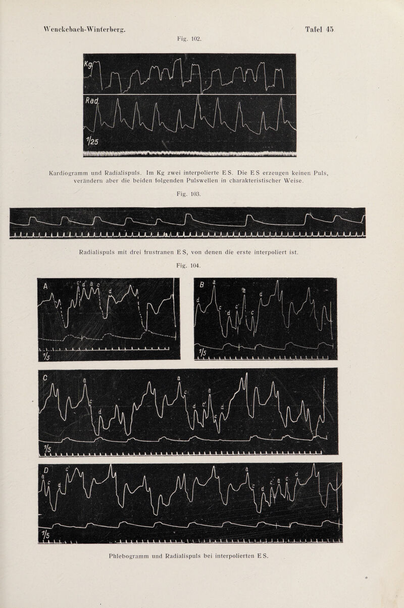 Fig. 102. Kardiogramm und Radialispuls. Im Kg zwei interpolierte ES. Die ES erzeugen keinen Puls, verändern aber die beiden folgenden Pulswellen in charakteristischer Weise. Fig. 103. Radialispuls mit drei frustranen E S, von denen die erste interpoliert ist. Fig. 104. Phlebogramm und Radialispuls bei interpolierten ES.