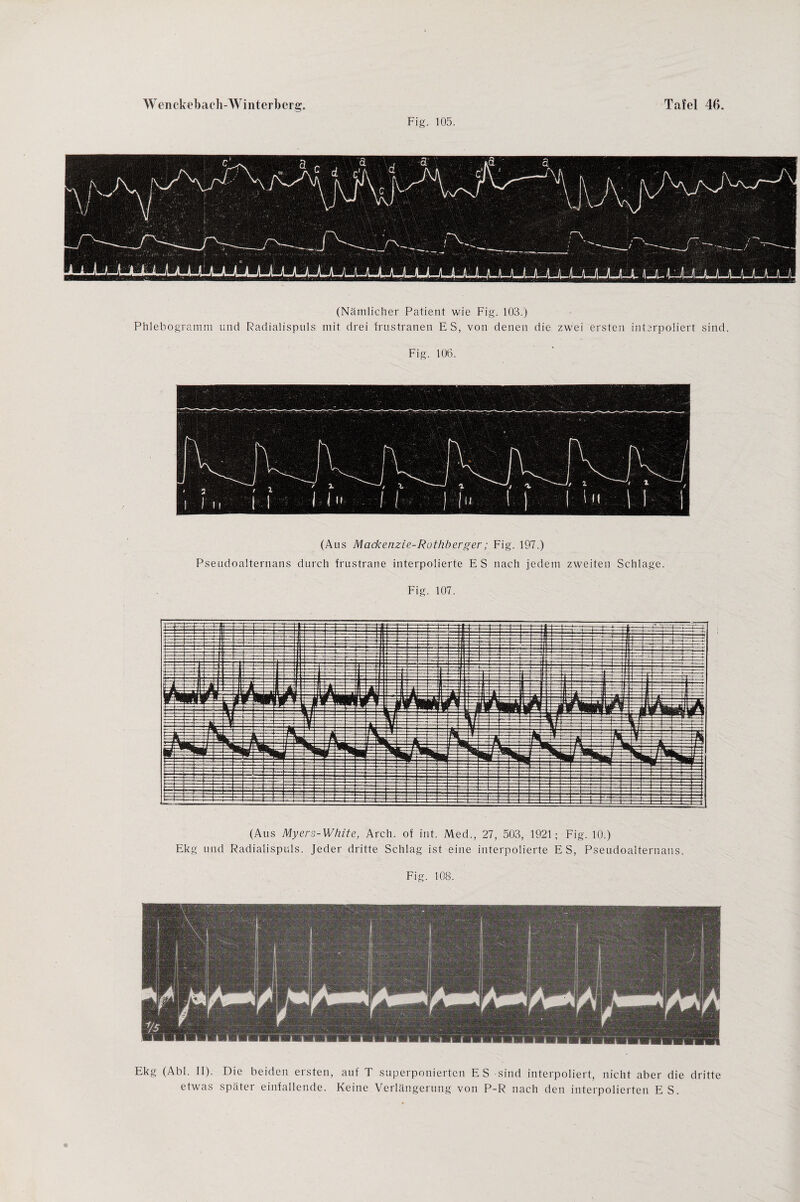 Fig. 105. (Nämlicher Patient wie Fig. 103.) Phlebogramm und Radialispuls mit drei frustranen ES, von denen die zwei ersten interpoliert sind. Fig. 106. (Aus Mackenzie-Rüthberger; Fig. 197.) Pseudoalternans durch frustrane interpolierte E S nach jedem zweiten Schlage. Fig. 107. (Aus Myers-White, Arch. of int. Med., 27, 503, 1921; Fig. 10.) Ekg und Radialispuls. Jeder dritte Schlag ist eine interpolierte ES, Pseudoalternans. Fig. 108. Ekg (Abi. II). Die beiden ersten, auf T superponiertcn ES sind interpoliert, nicht aber die dritte etwas später einfallende. Keine Verlängerung von P-R nach den interpolierten ES.