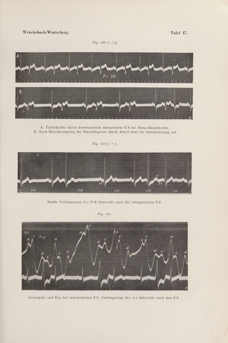 Fig. 109 (X:!A). A. Tachykardie durch kontinuierlich interpolierte ES bei Sinus-Bradykardie. B. Nach Beschleunigung der Sinusfrequenz durch Arbeit hört die Interpolierung auf. Fig. 110 (X 4(';->)• Starke Verlängerung des P-R Intervalls nach der interpolierten ES. Venenpuls und Ekg bei interpolierten ES. Verlängerung des a-c Intervalls nach den ES. m