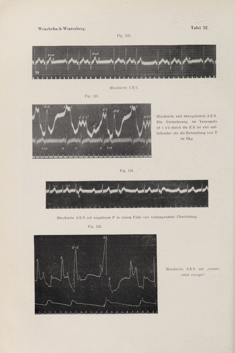 Fig. 122. Blockierte A E S. Fig. 123. Blockierte und übergeleitete A E S. Die Veränderung im Venenpuls (d -j- a ) durch die E S ist viel auf¬ fallender als die Entstellung von T im Ekg. Fig. 124. Blockierte AES mit negativem P in einem Falle von verlangsamter Überleitung.