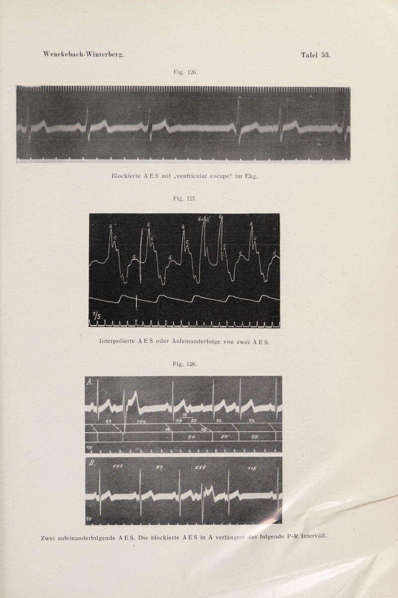 Blockierte A E S mit „ventricular escape“ im Ekg. Fig. 127. Interpolierte AES oder Aufeinanderfolge von zwei A E S. Fig. 128. Zwei aufeinanderfolgende AES. Die blockierte A E S in A verlängert das folgende P R Intervall.