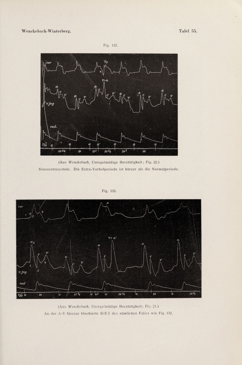 Fig. 132. (Aus Wenckebach, Unregelmäßige Herztätigkeit; Fig. 22.) Sinusextrasystole. Die Extra-Vorhofperiode ist kürzer als die Nonnalperiode. Fig. 133. (Aus Wenckebach, Unregelmäßige Herztätigkeit; Fig. 21.) An der A-V Grenze blockierte Si E S des nämlichen Falles wie Fig. 132.