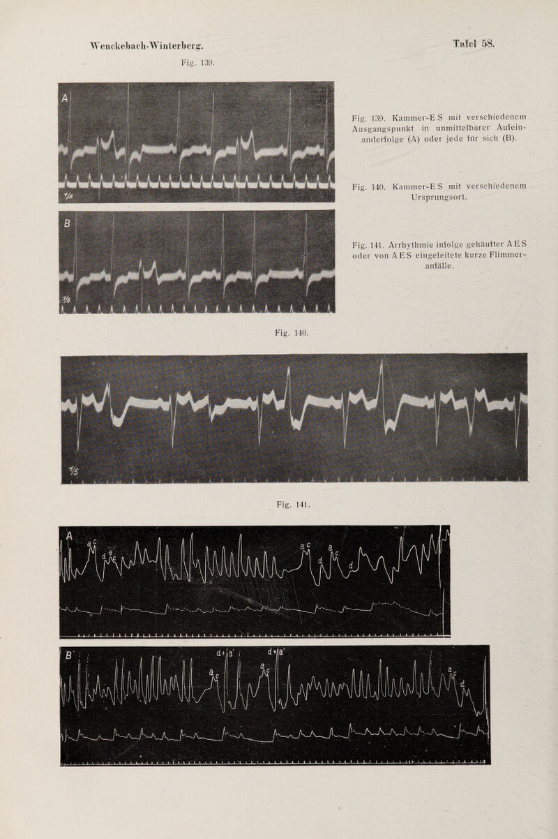 Fig. 139. Fig. 139. Kammer-E S mit verschiedenem Ausgangspunkt in unmittelbarer Aufein¬ anderfolge (A) oder jede für sich (B). Fig. 140. Kammer-E S mit verschiedenem Ursprungsort. Fig. 141. Arrhythmie infolge gehäufter AES oder von AES eingeleitete kurze Flimmer¬ anfälle. Fig. 140.