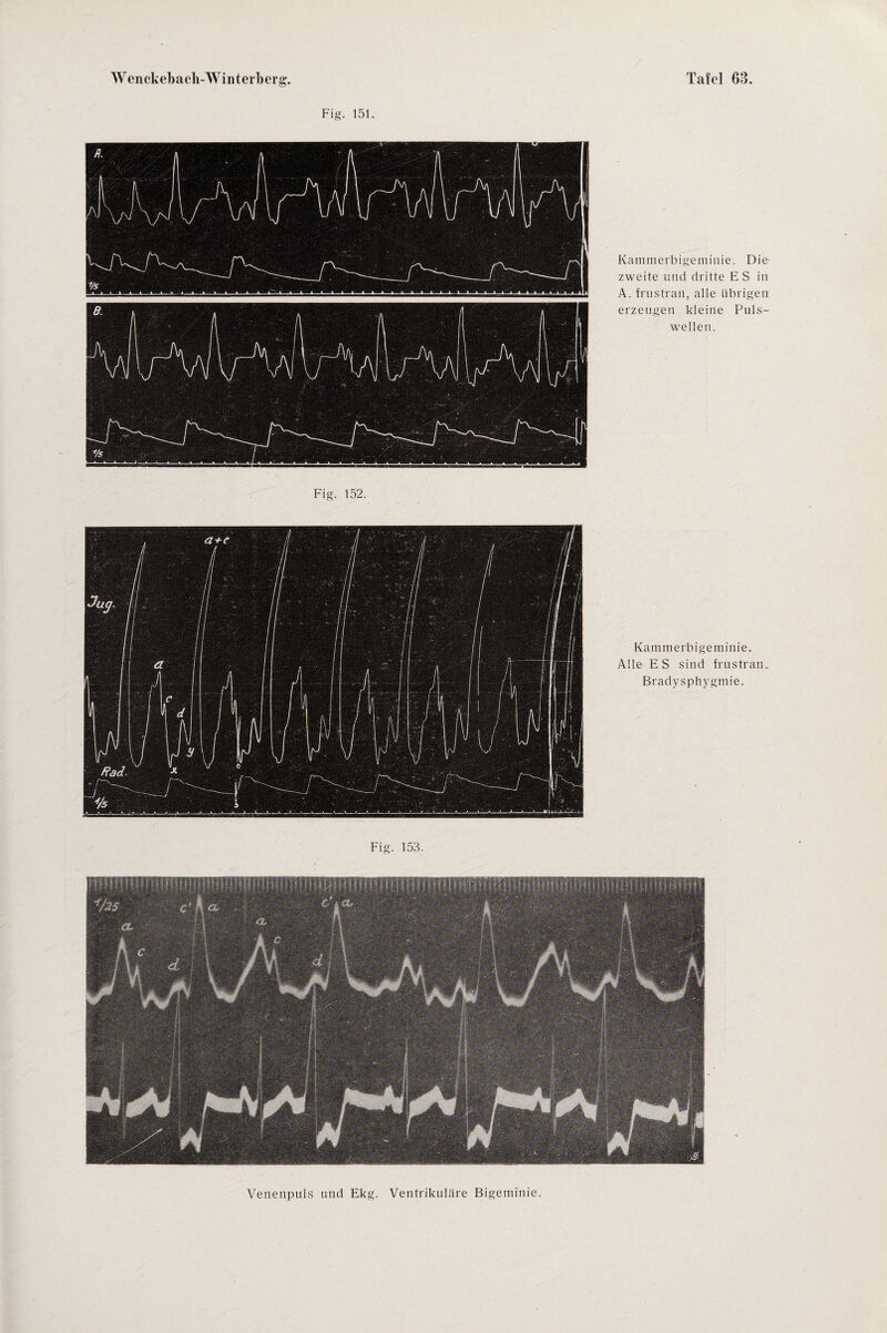 Fig. 151. Kammerbigeminie. Die zweite und dritte E S in A. frustran, alle übrigen erzeugen kleine Puls¬ wellen. Fig. 152. Kammerbigeminie. Alle ES sind frustran. Bradysphygmie. Fig. 153. Venenpuls und Ekg. Ventrikuläre Bigeminie.