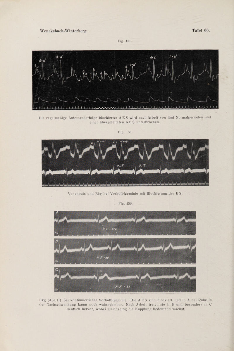 Fig. 157. Die regelmäßige Aufeinanderfolge blockierter AES wird nach Arbeit von fünf Normalperioden und einer übergeleiteten AES unterbrochen. Fig. 158. Venenpuls und Ekg bei Vorhofbigeminie mit Blockierung der E S. Fig. 159. Ekg (Abi. II)’ bei kontinuierlicher Vorhofbigeminie. Die AES sind blockiert und in A bei Ruhe in der Nachschwankung kaum noch wahrnehmbar. Nach Arbeit treten sie in B und besonders in C deutlich hervor, wobei gleichzeitig die Kupplung bedeutend wächst.