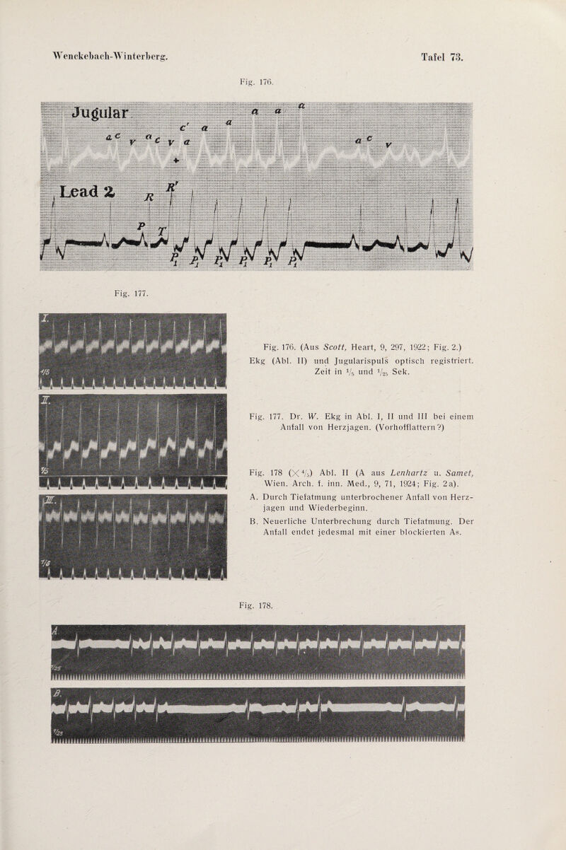 Fig. 176. Fig. 177. Fig. 176. (Aus Scott, Heart, 9, 297, 1922; Fig. 2.) Ekg (Abi. II) und Jugularispuls optisch registriert. Zeit in 1/b und V25 Sek. Fig. 177. Dr. W. Ekg in Abi. I, II und III bei einem Anfall von Herzjagen. (Vorhofflattern?) Fig. 178 (X 4/5) Abi. II (A aus Lenhartz u. Samet, Wien. Arch. f. hin. Med., 9, 71, 1924; Fig. 2a). A. Durch Tiefatmung unterbrochener Anfall von Herz¬ jagen und Wiederbeginn. B. Neuerliche Unterbrechung durch Tiefatmung. Der Anfall endet jedesmal mit einer blockierten As. Fig. 178.