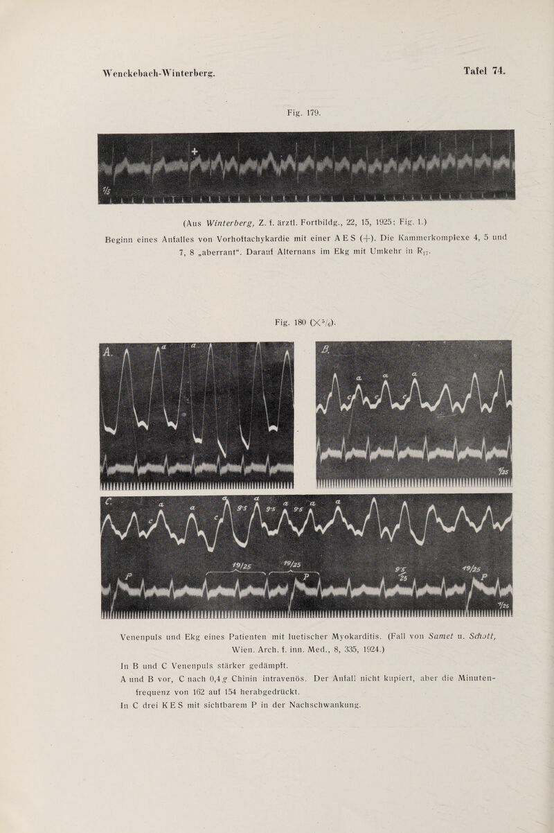 Fig. 179. (Aus Winterberg, Z. f. ärztl. Fortbildg., 22, 15, 1925; Fig. 1.) Beginn eines Anfalles von Vorhoftachykardie mit einer AES (+). Die Kammerkomplexe 4, 5 und 7, 8 „aberrant“. Darauf Alternans im Ekg mit Umkehr in Rn. Fig. 180 (X5/e)- Venenpuls und Ekg eines Patienten mit luetischer Myokarditis. (Fall von Samet u. Schott, Wien. Arch. f. inn. Med., 8, 335, 1924.) In B und C Venenpuls stärker gedämpft. A und B vor, C nach 0,4g Chinin intravenös. Der Anfall nicht kupiert, aber die Minuten¬ frequenz von 162 auf 154 herabgedrückt. In C drei KES mit sichtbarem P in der Nachschwankung.