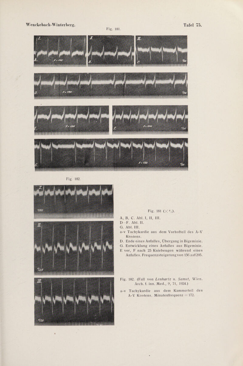Fig. 181. Fig. 182. Fig. 181 (X4A)- A, B, C. Abi. I, II, III. D—F. Abi. II. G. Abi. III. a-v Tachykardie aus dein Vorhofteil des A-V Knotens. D. Ende eines Anfalles, Übergang in Bigeminie. G. Entwicklung eines Anfalles aus Bigemitiie. E vor, F nach 25 Kniebeugen während eines Anfalles. Frequenzsteigerungvon 156 auf 205. Fig. 182. (Fall von Lcnhartz u. Samet, Arch. f. inn. Med., 9, 71, 1924.) Wien. a-v Tachykardie aus dem Kannnerteil des A-V Knotens. Minutenfrequenz = 172. liMlMIt!