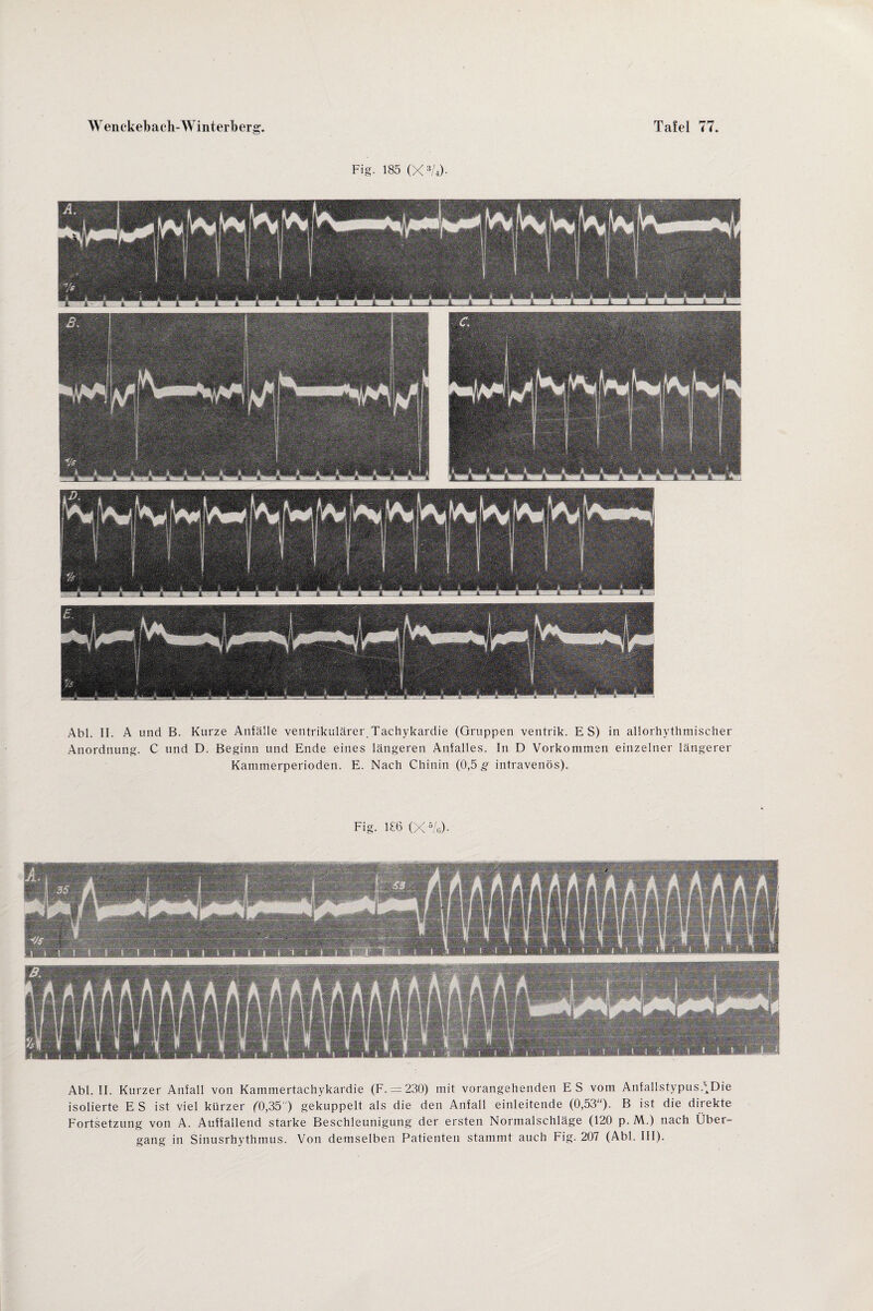 Fig. 185 (X3U)- Abi. II. A und B. Kurze Anfälle ventrikulärer.Tachykardie (Gruppen ventrik. ES) in allorhythmischer Anordnung. C und D. Beginn und Ende eines längeren Anfalles. In D Vorkommen einzelner längerer Kammerperioden. E. Nach Chinin (0,5 g- intravenös). Fig. 186 (X5/g). Abi. II. Kurzer Anfall von Kammertachykardie (F. — 230) mit vorangehenden ES vom Anfallstypus.f;Die isolierte E S ist viel kürzer ('0,35' ) gekuppelt als die den Anfall einleitende (0,53). B ist die direkte Fortsetzung von A. Auffallend starke Beschleunigung der ersten Normalschläge (120 p. M.) nach Über¬ gang in Sinusrhythmus. Von demselben Patienten stammt auch Fig. 207 (Abi. III).