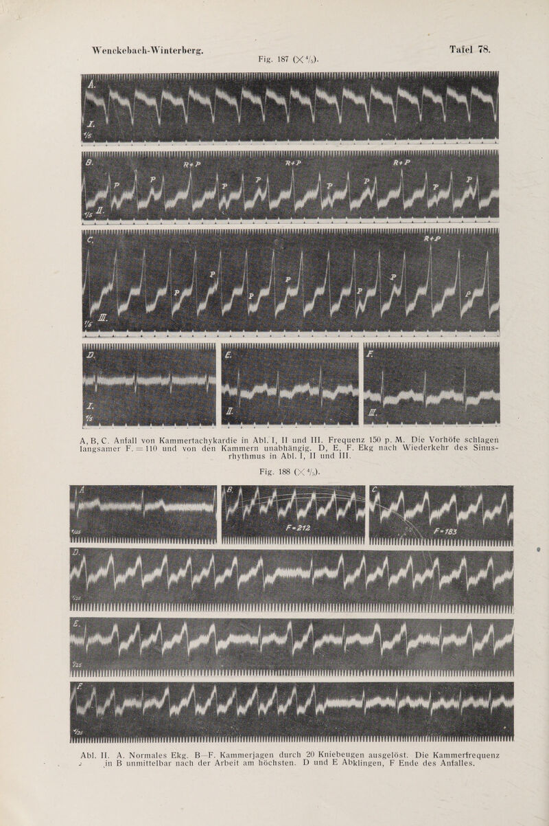 Fig. 187 (X 4/5)- HtlimHllHlillHlUllilii A, B, C. Anfall von Kammertachykardie in Abi. I, II und III. Frequenz 150 p. M. Die Vorhöfe schlagen langsamer F. = 110 und von den Kammern unabhängig. D, E, F. Ekg nach Wiederkehr des Sinus¬ rhythmus in Abi. I, II und III. Fig. 188 (X4A). Abi. II. A. Normales Ekg. B—F. Kammerjagen durch 20 Kniebeugen ausgelöst. Die Kammerfrequenz in B unmittelbar nach der Arbeit am höchsten. D und E Abklingen, F Ende des Anfalles.