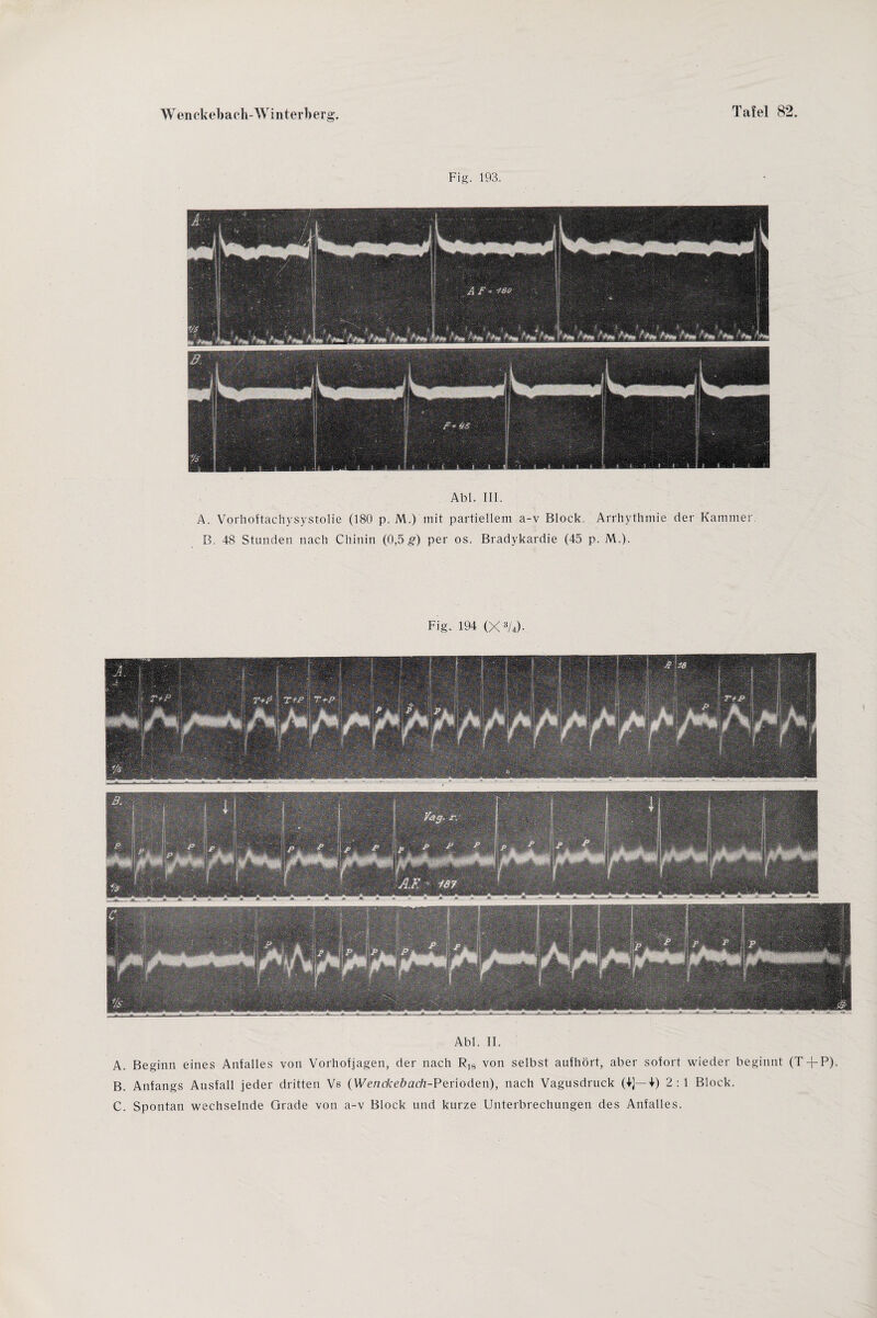 Fig. 193. Abi. III. A. Vorhoftachysystolie (180 p. M.) mit partiellem a-v Block. Arrhythmie der Kammer B. 48 Stunden nach Chinin (0,5 £) per os. Bradykardie (45 p. M.). Fig. 194 (X3/4)- Abi. II. A. Beginn eines Anfalles von Vorhofjagen, der nach Rl8 von selbst aufhört, aber sofort wieder beginnt (T-fP) B. Anfangs Ausfall jeder dritten Vs (Wenckebach-Perioden), nach Vagusdruck (4]—4) 2: 1 Block. C. Spontan wechselnde Grade von a-v Block und kurze Unterbrechungen des Anfalles.