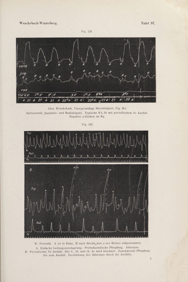 Fig. 228. (Aus Wenckebach, Unregelmäßige Herztätigkeit; Fig. 38.) Spitzenstoß, Jugularis- und Radialispuls. Typische R L St mit periodischem Vs Ausfall. Negative a-Zacken im Kg. Fig. 229. W. Periodik. A ist in Ruhe, B nach Hochheben e nes Beines aufgenommen. A. Einfache Leitungsverzögerung. Protodiastolische Pfropfung. Alternans. B. Periodischer Vs Ausfall. Die 6., 10. und 14. As wird blockiert. Zunehmende Pfropfung bis zum Ausfall. Verstärkung des Alternans durch die Ausfälle. 7
